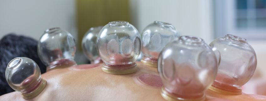 cupping traditional Chinese medicine