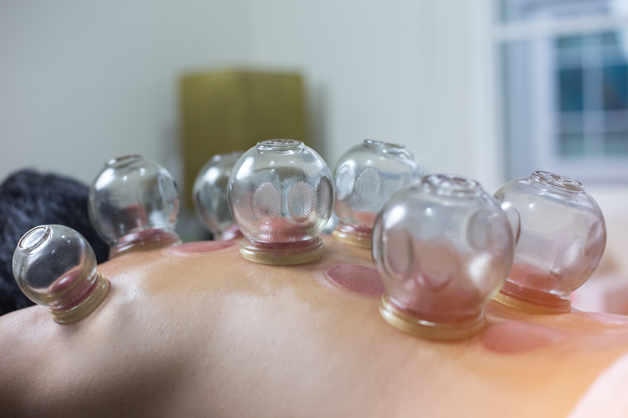 Cupping Therapy Katie Gaffney OMD L Ac